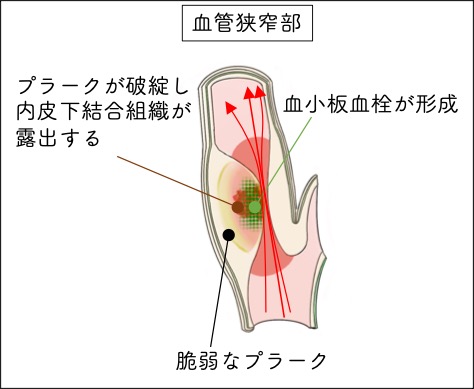 プラーク形成と血小板血栓