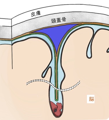 クモ膜下出血