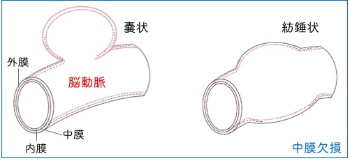 未破裂脳動脈瘤