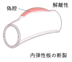 未破裂脳動脈瘤