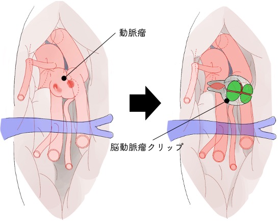 どちらの治療を選択するか