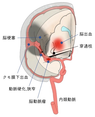 脳卒中について