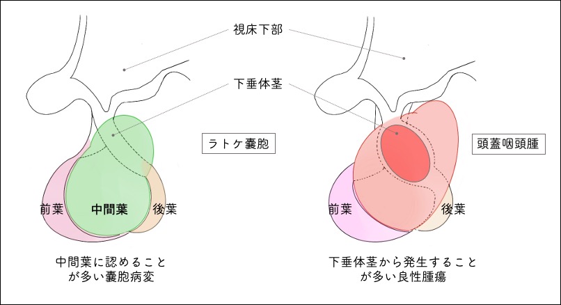下垂体にできる病気