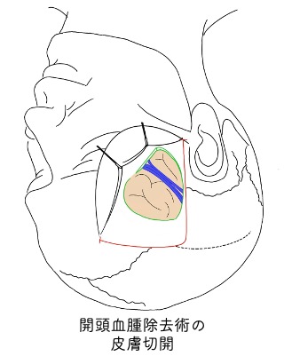 外科的治療(手術)