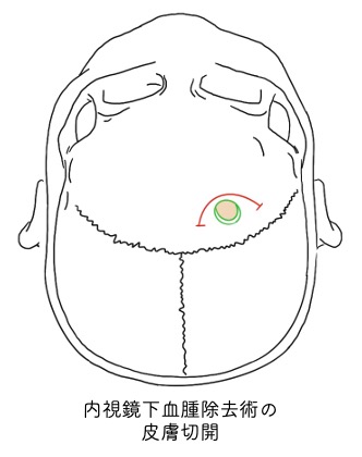 神経内視鏡下血腫除去術