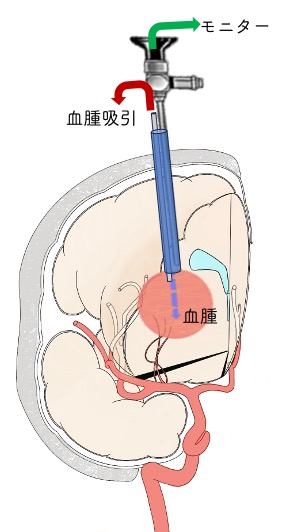 神経内視鏡下血腫除去術