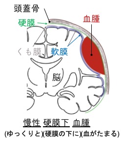 慢性硬膜下血腫とは