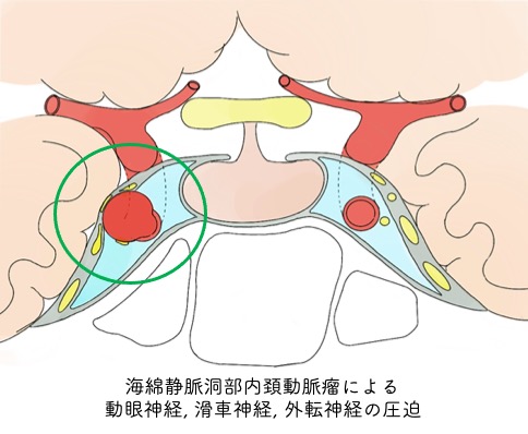 未破裂脳動脈瘤について